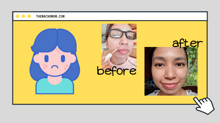 This Simple Skincare Routine Cleared my Acne by Surprise!