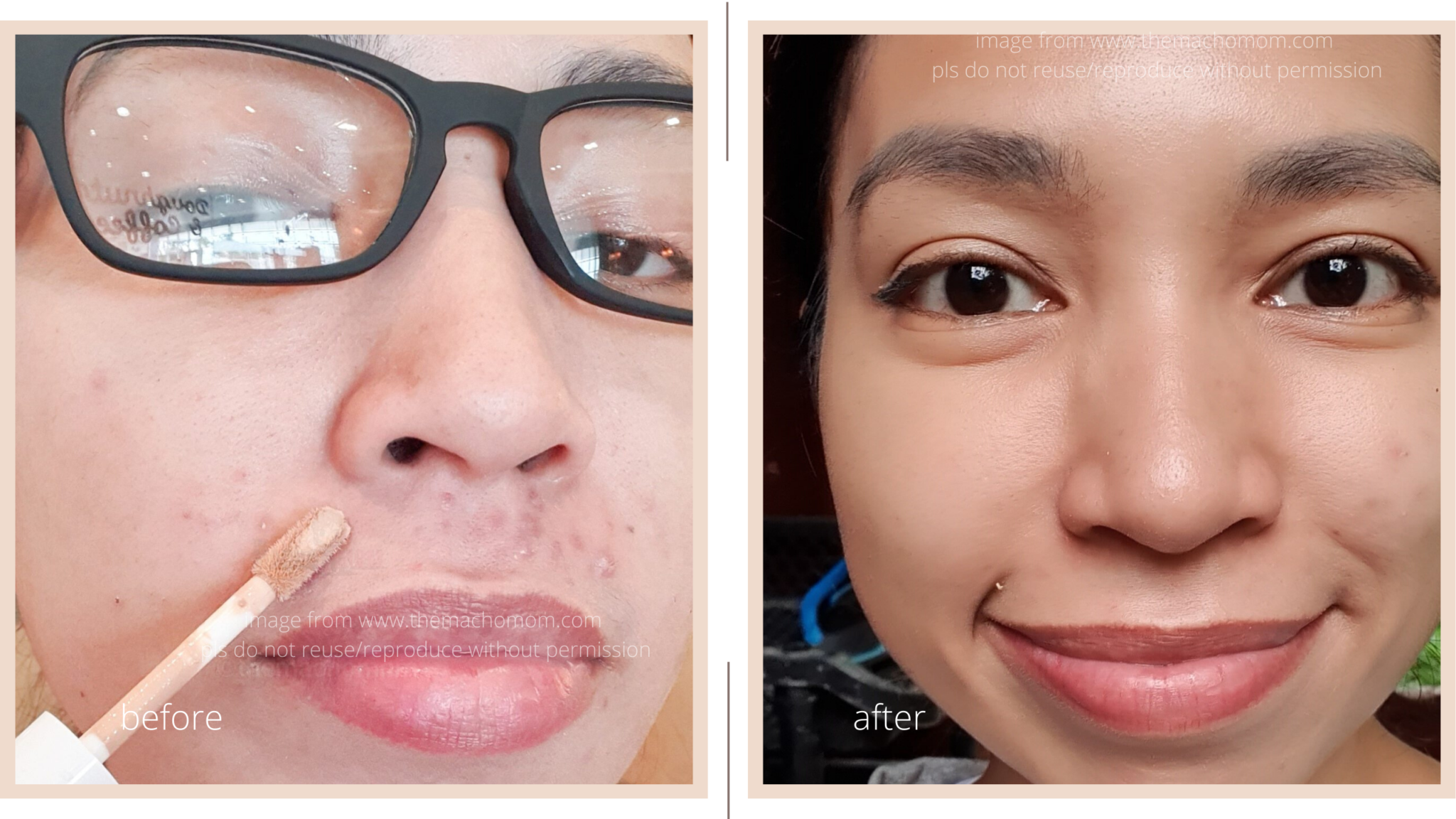 This Simple Skincare Routine Cleared my Acne by Surprise!